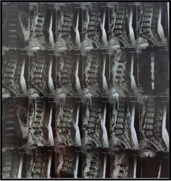 sciatica-diagnosis:-disc-vs-piriformis