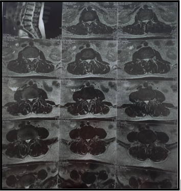 sciatica-diagnosis:-disc-vs-piriformis